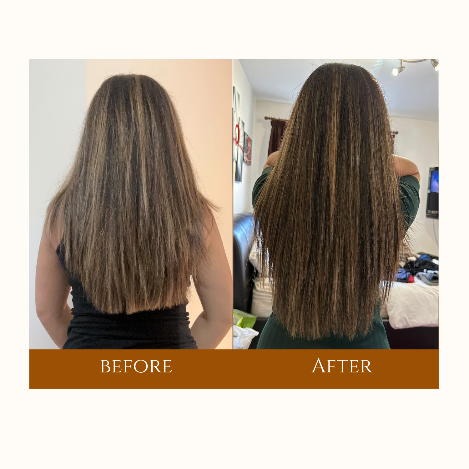 Hair restoration before-and-after showing fuller results post-transplant.