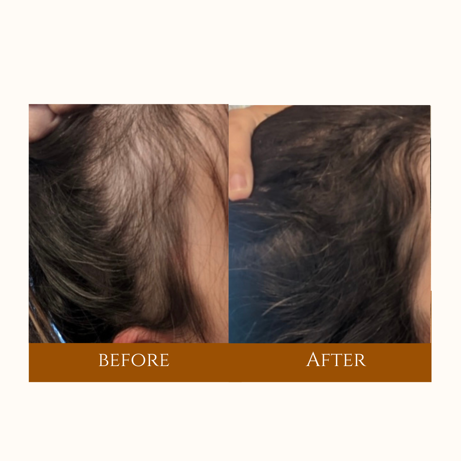 Before and after images showcasing the results of a hair transplant procedure, highlighting significant hair restoration.