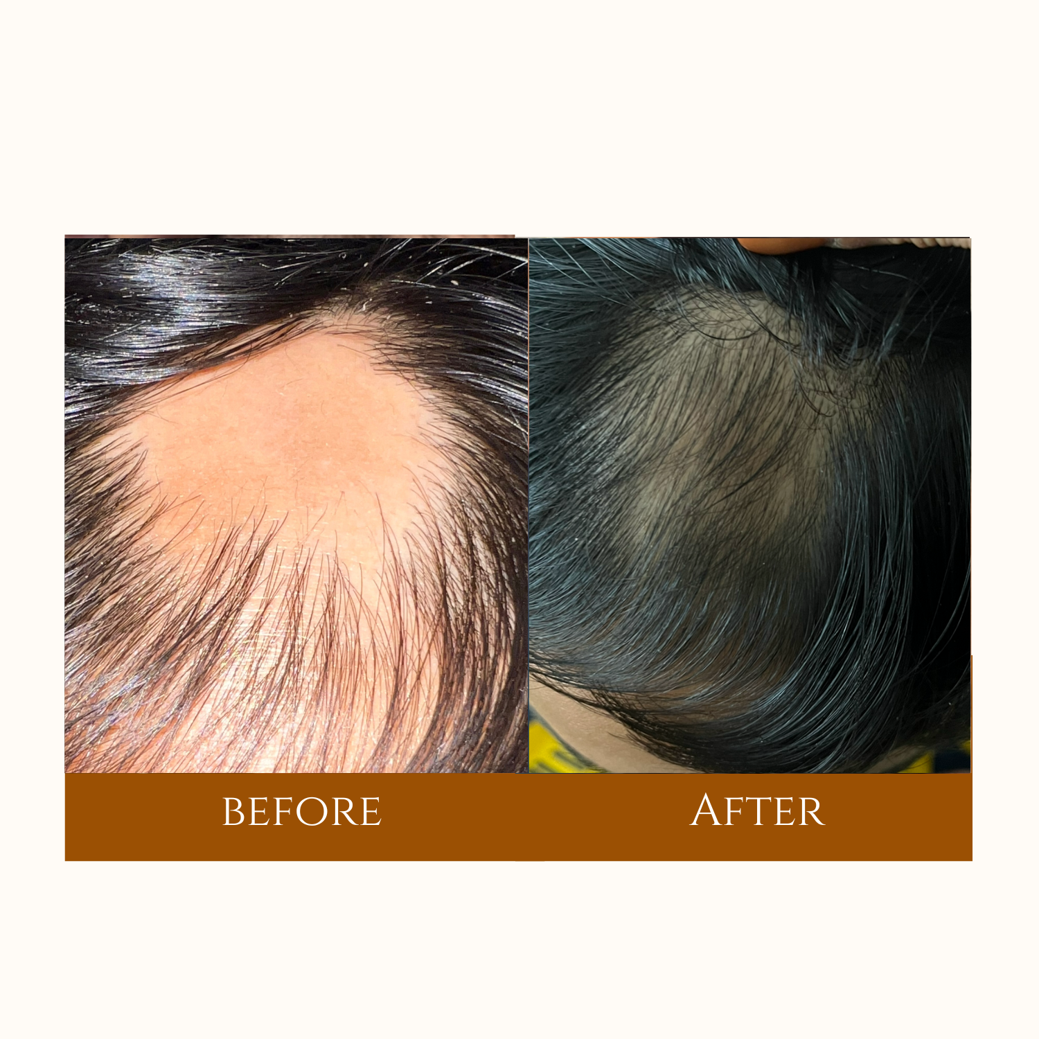 Visual representation of hair restoration, featuring before and after photos of a hair transplant with enhanced fullness.