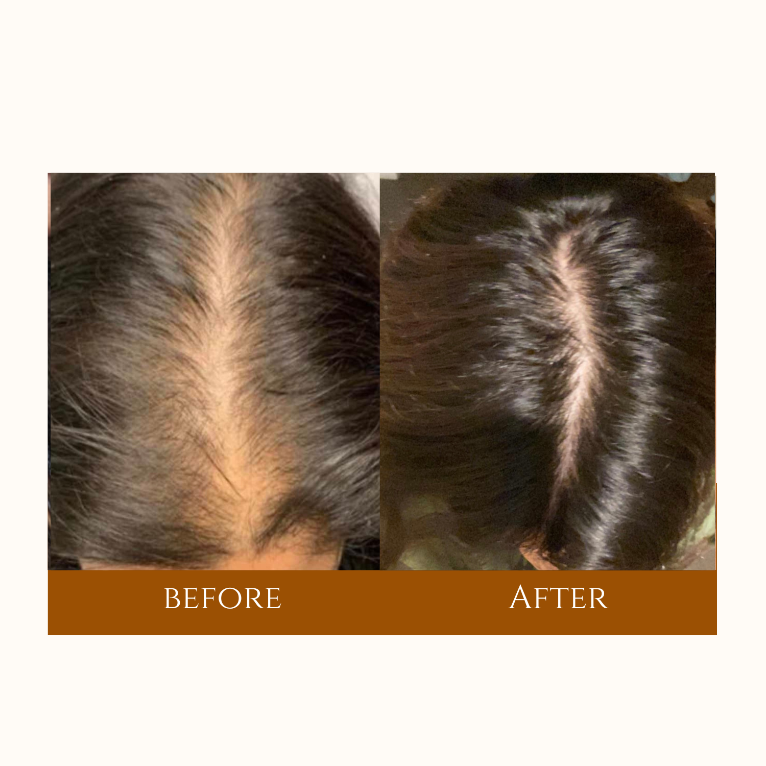 Comparison image showing hair loss before and the fuller appearance after a successful hair transplant procedure.