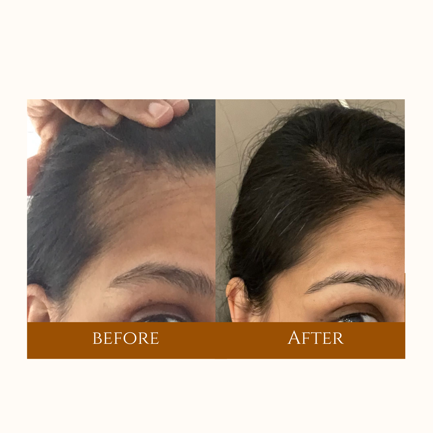 Visual comparison of hair restoration results, showcasing before and after images highlighting enhanced hair fullness following a transplant.