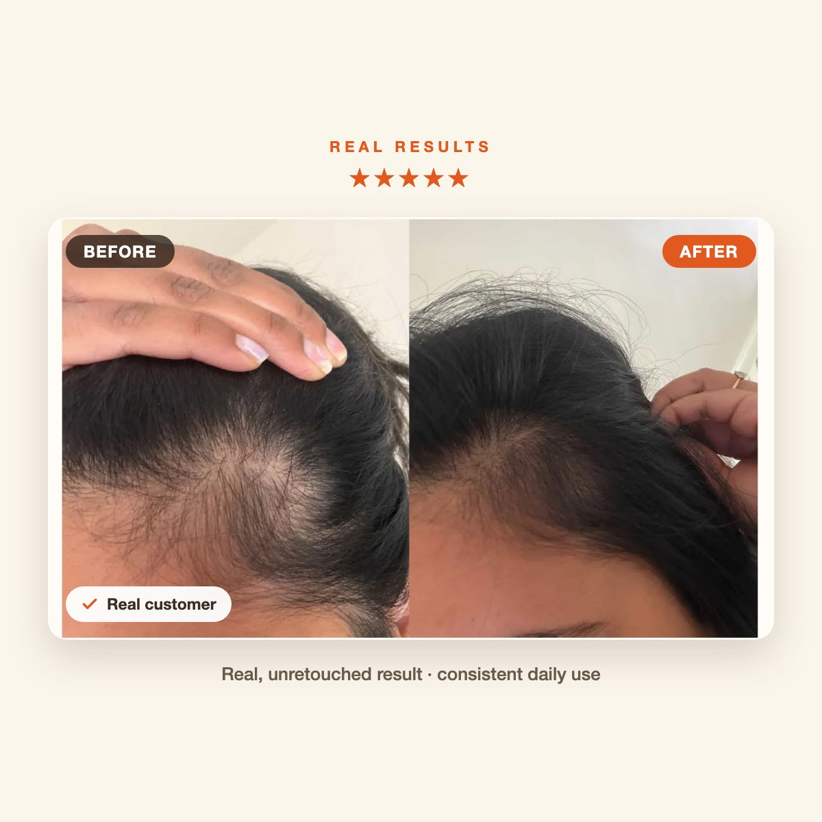 Hair Veda Avani real customer before and after hair growth result